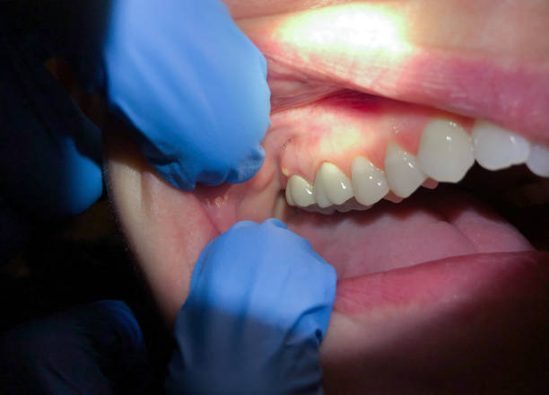 Best Broken Tooth Emergency  in Lake Mawk, OH